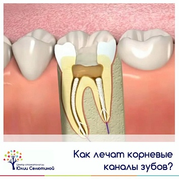 Как лечат корневые каналы зубов? 