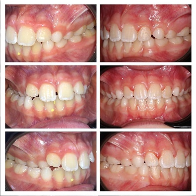 Фото до и после: первый этап исправления перекрестного прикуса - Happy Dents