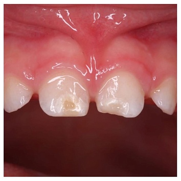Гипоплазия молочных зубов