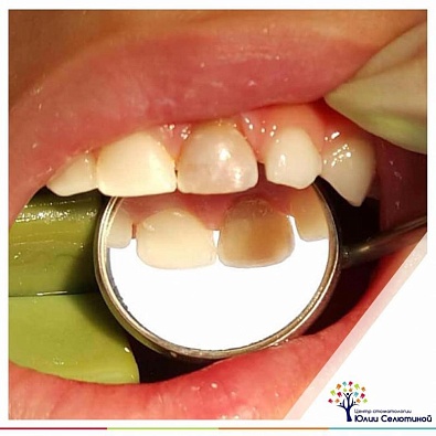 Хлоргексидин в стоматологии и желтизна зубов – какая связь