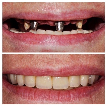 Восстановление зубов с помощью ортопедии