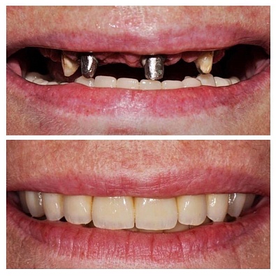 Восстановление зубов с помощью ортопедии