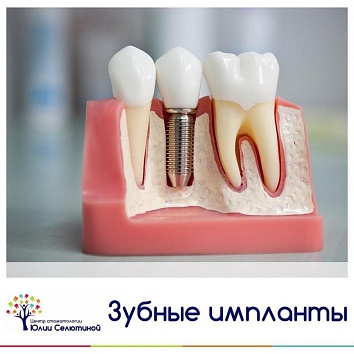 Зубные импланты.