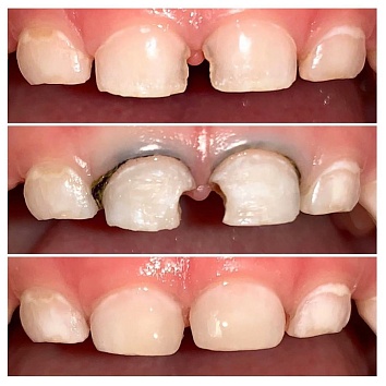 Реставрация центральных молочных зубов.
