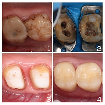 Как перелечивали и восстанавливали сразу два зуба 
