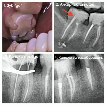 Клинический случай: перелечивание "красного зуба" 