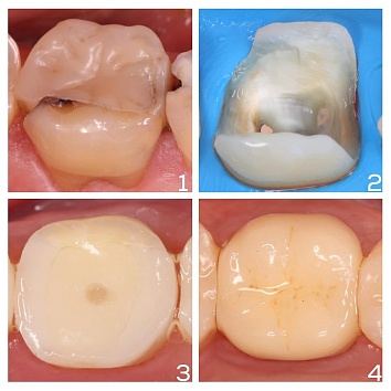 Перелечивание и восстановление приговоренного к удалению зуба 