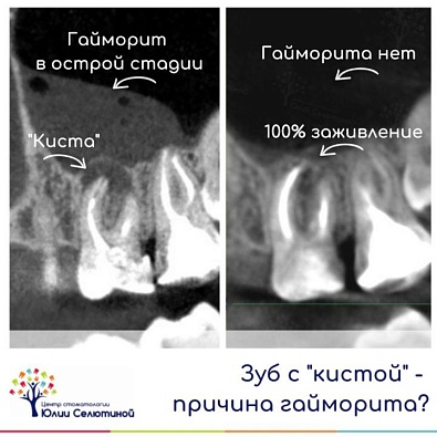 Может ли зуб с "кистой" быть причиной гайморита? 