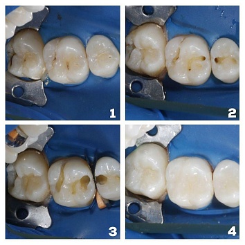 Лечение кариеса нескольких зубов одномоментно