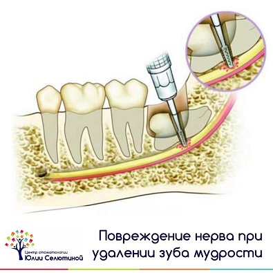 Парестезия после удаления зуба – что это такое?