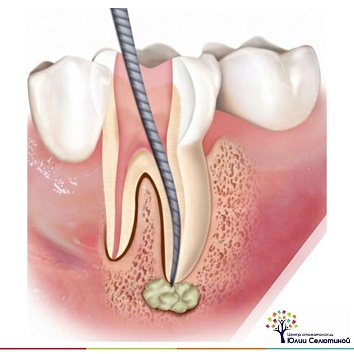 Причины зубной боли: гранулема.
