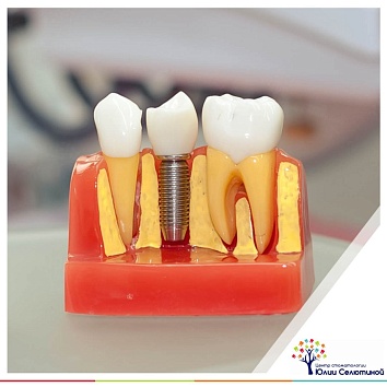 ТОП-5 вопросов об имплантации зубов.