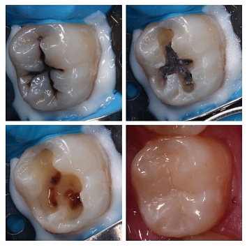 Лечение кариеса постоянного зуба с восстановлением его анатомии. 