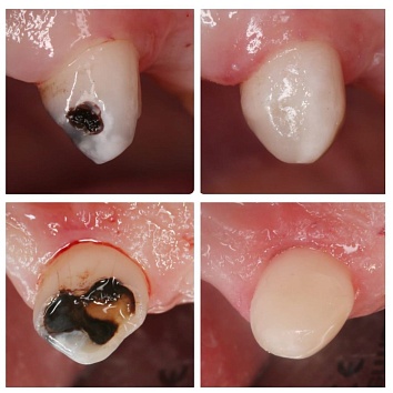Как серебрение зубов маскирует кариес 