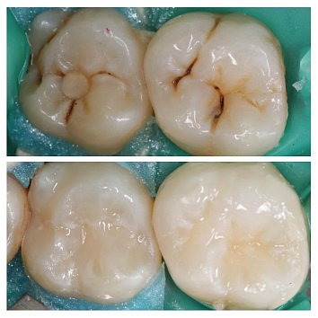 Клинический случай: лечение кариеса постоянных зубов 