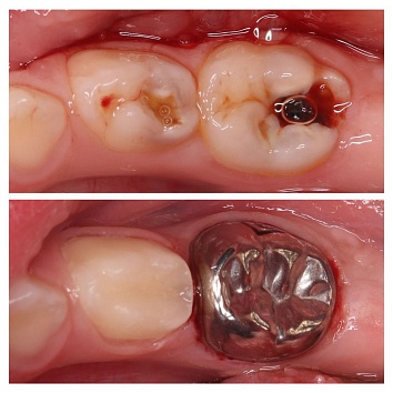 Какие есть способы восстановления молочного зуба, если он разрушен очень сильно? 