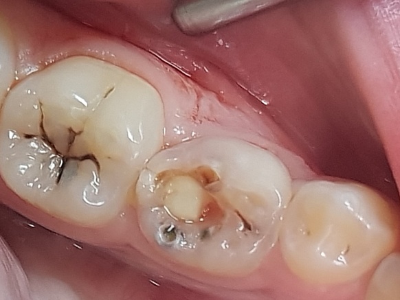 Лечение кариеса постоянного зуба у ребенка 12 лет