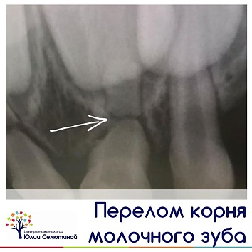 Как выявить перелом корня молоного зуба?