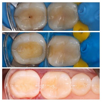 Восстановление контакта между зубами.