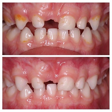 Клинический случай: преждевременная потеря центрального молочного зуба