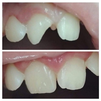 Восстановление постоянного центрального зуба