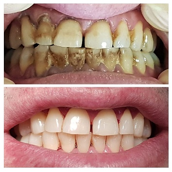 Природная санация зубов в практике стоматолога 