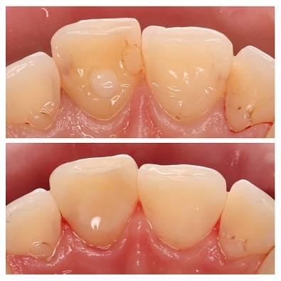 Лечение кариеса центральых зуб у взрослого 