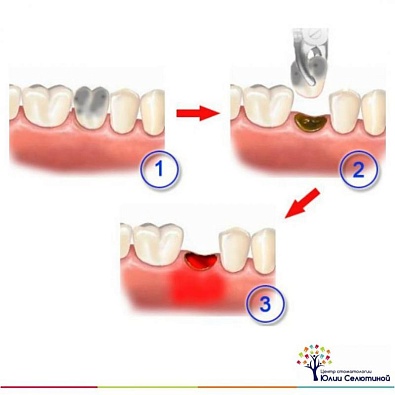 Альвеолит лунки зуба – серьезное осложнение после удаления зуба