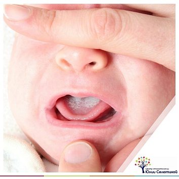 Молочница у ребёнка: симптомы и лечение. 