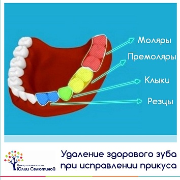 Удаление зуба по ортодонтическим показаниям.