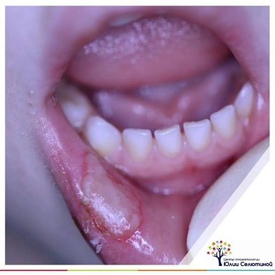 Опухла губа после лечения зуба — советы стоматологов | Стоматологическая практика