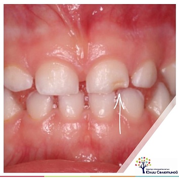 Белые пятна (точки) на зубах у ребенка - причины, симптомы, диагностика, лечение, профилактика