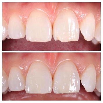 Реставрации зубов без препарирования.