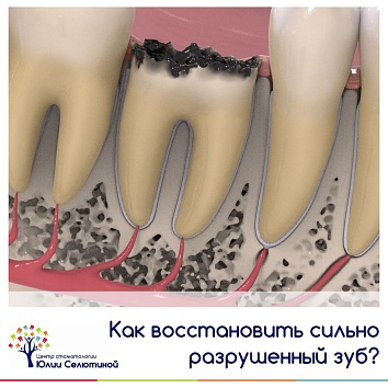 Как восстановить сильно разрушенный зуб? 