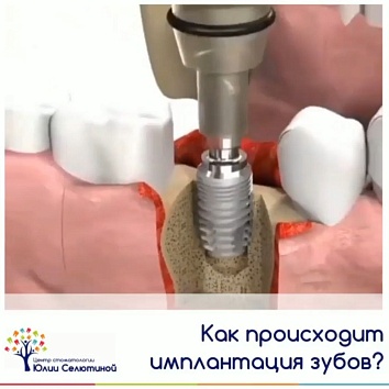 Как происходит имплантация зубов? 