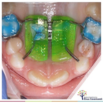 Ортодонтическое лечение на аппарате Хаас