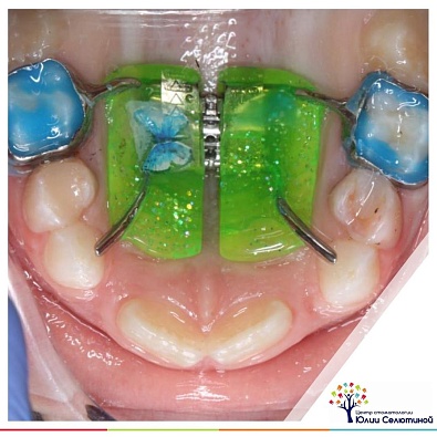 Ортодонтическое лечение на аппарате Хаас