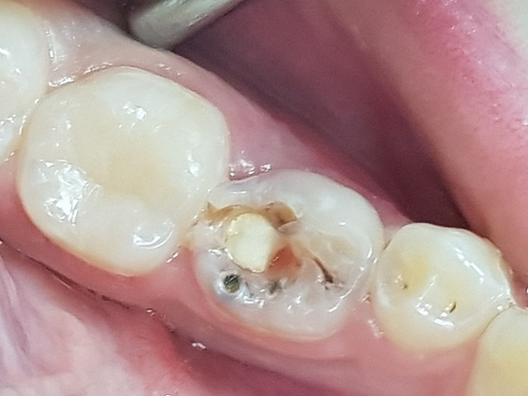 Лечение кариеса постоянного зуба у ребенка 12 лет