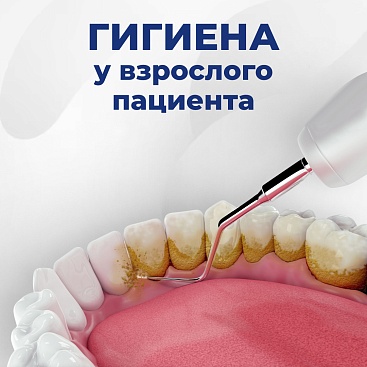 Почему возникает зубной камень? 