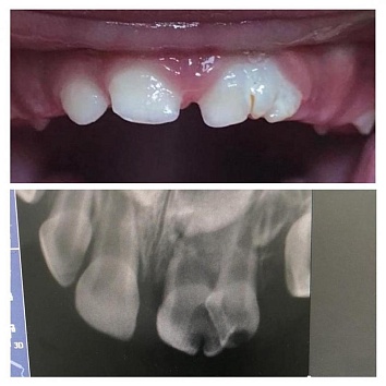 Клинический случай: "срощенный" зуб
