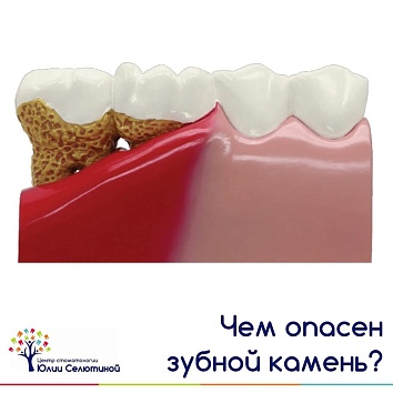 Чем опасен зубной камень? 
