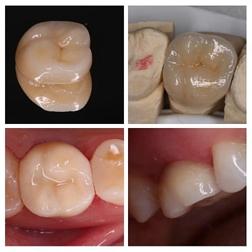 Восстановление разрушенных зубов коронками E-MAX