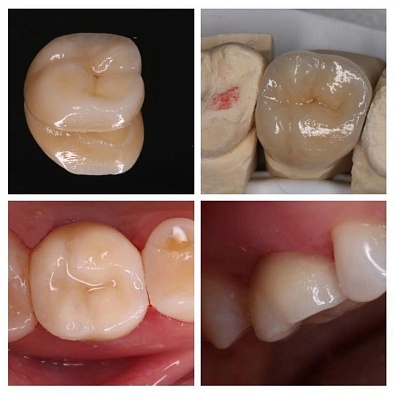 Восстановление разрушенных зубов коронками E-MAX