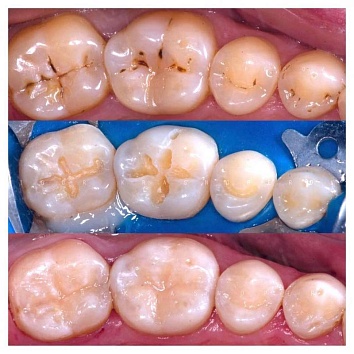 Лечение кариеса постоянных зубов.