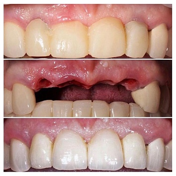 Восстановление центральных зубов за одно посещение