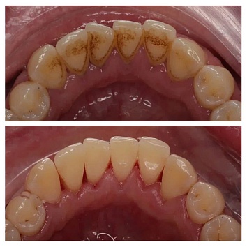 Снятие пигментированного налета в кабинете стоматолога 