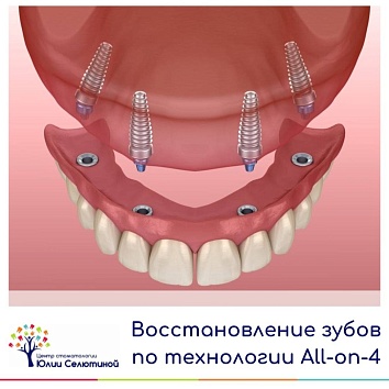 Восстановление на имплантах при полном отсутствии зубов 