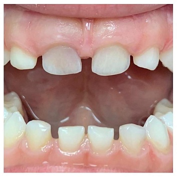 О чем говорит потемнение зуба?