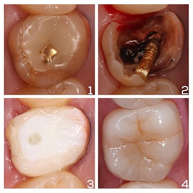 Подготовка резорциненного зуба к протезированию 