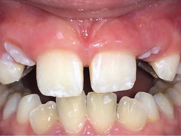 Ортодонтическое лечение в сменном прикусе (пациенту 8 лет)